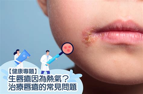 上唇生暗瘡|唇瘡怎解決？ 成因、治療方法及藥膏推薦｜多吃這些 